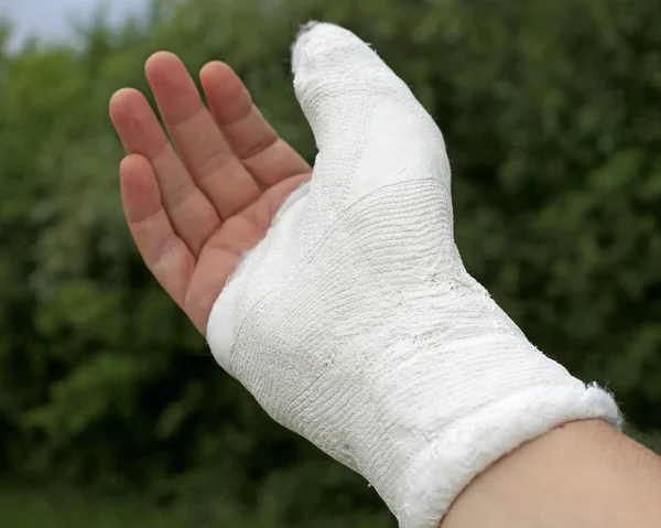 Ranny Ręka Osoby Poszkodowanej Złamaniu Prawy Kciuk Paliczka — Zdjęcie stockowe
