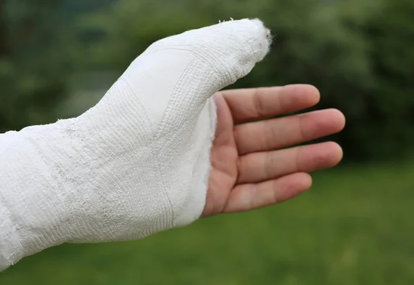 Hand Ont Med Medicinsk Gips Avgjutning Efter Att Bryta Falangen — Stockfoto