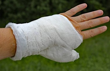 yaralı el başparmak falanks kırılması sonra döküm ile
