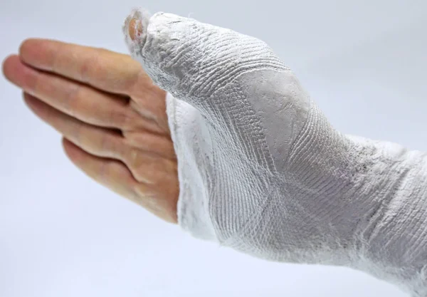 不慮の事故による親指の骨折後の緊急治療室で男の手 — ストック写真