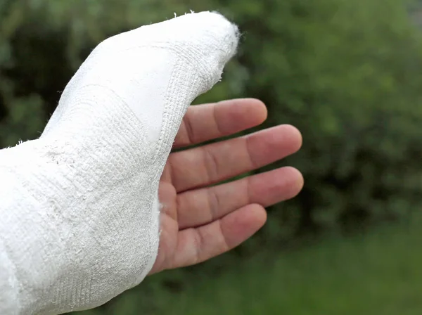 Ranny Ręka Osoby Poszkodowanej Złamania Paliczka Kciuka — Zdjęcie stockowe