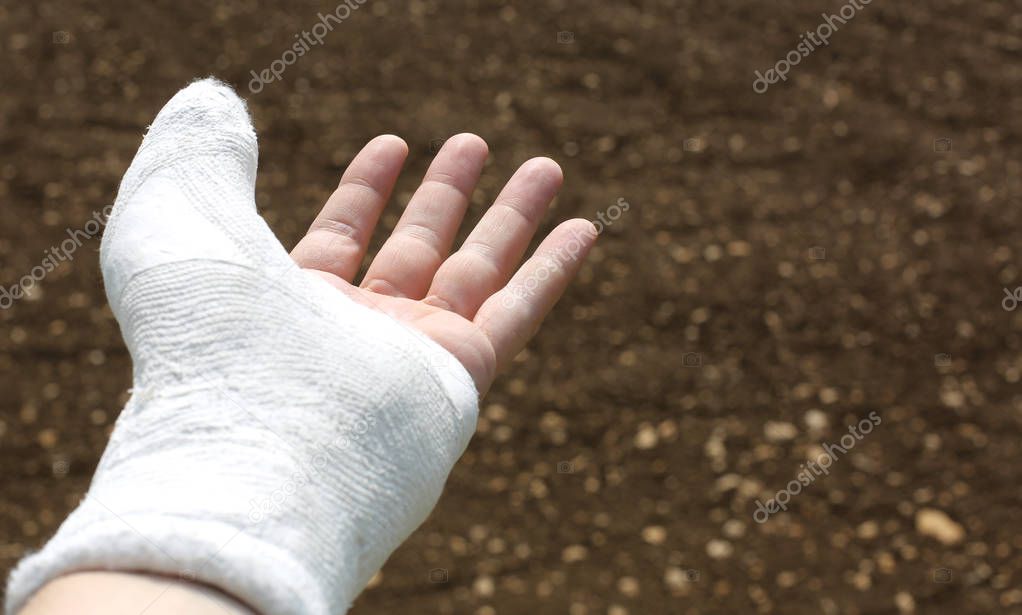 Hand of the injured person with the bone fracture of the thumb