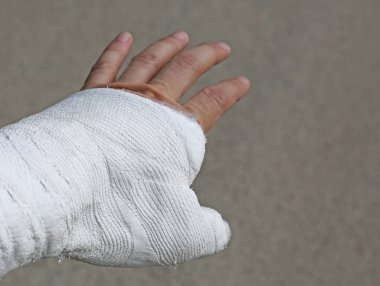 el başparmak kemik kırığı nedeniyle sıvalı