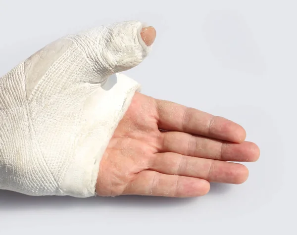 Mężczyzna Złamania Ręki Kredą Unieruchomienie Kciuk Złamania Kości — Zdjęcie stockowe