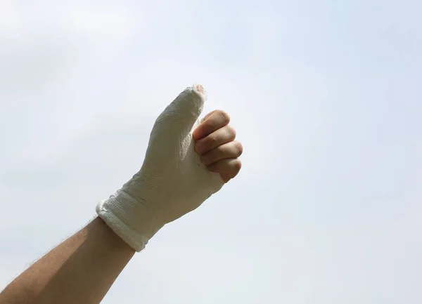 受伤的人的手 谁竖起拇指完全蒙眼后骨骨折似乎说我喜欢它 — 图库照片