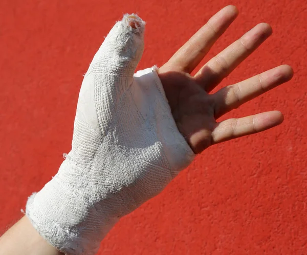 Fractured Hand Plaster Red Background — Stock Photo, Image