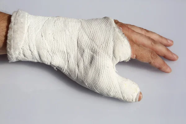 Fractured Thumb Bone Bandage Immobilize Broken Finger White Background — Stock Photo, Image