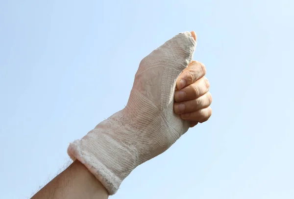 the fractured hand and the plaster cast in the hospital with the thumb up in a sign of Like