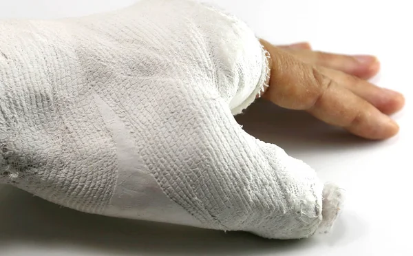 Hand Emergency Room Fracture Thumb White Background — Stock Photo, Image