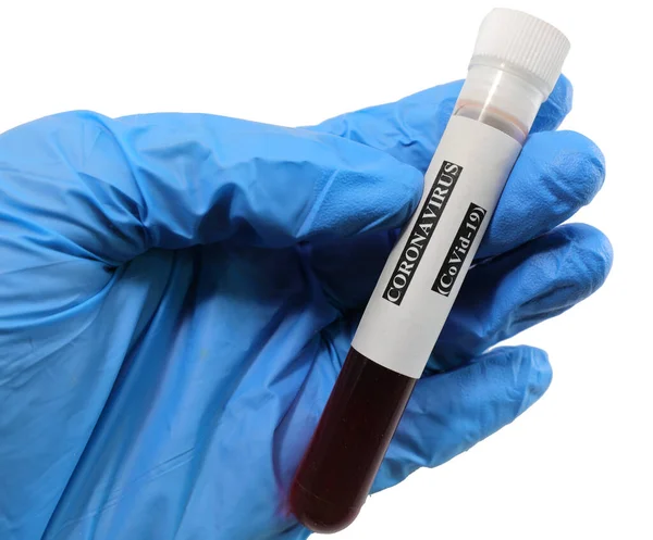 Ręka Lekarza Próbką Krwi Przeprowadzenia Testu Serologicznego Celu Wykrycia Przeciwciał — Zdjęcie stockowe