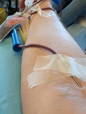 Kanülü bir adamın kolu ve nakil sırasında hastane ortamında kanül dolusu kan yerleştirilmiş.