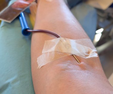 Hastanede kan nakli sırasında iğneli gönüllü kol.