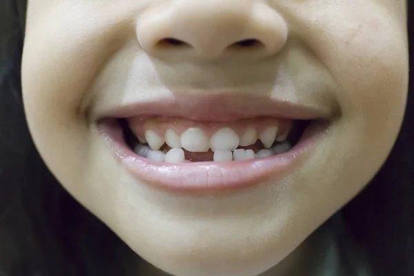 Закрыть Маленькую Девочку Показывающую Потерянный Зуб — стоковое фото