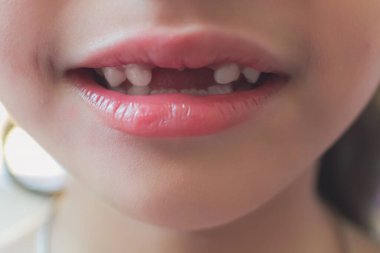 Kayıp süt dişli kızı kapat.