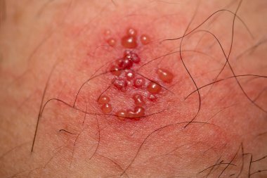 deri döküntüsü ve vücut (zona erkekler herpes zoster üzerinde üzerinde kabarcıklar)