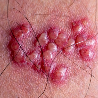 skin rash and blisters on body(Shingles on men herpes zoster) clipart