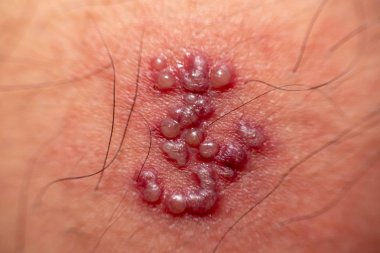 deri döküntüsü ve vücut (zona erkekler herpes zoster üzerinde üzerinde kabarcıklar)