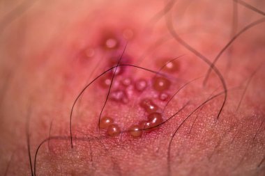 deri döküntüsü ve vücut (zona erkekler herpes zoster üzerinde üzerinde kabarcıklar)