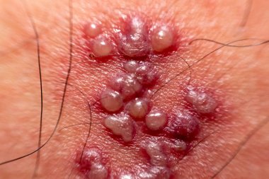 deri döküntüsü ve vücut (zona erkekler herpes zoster üzerinde üzerinde kabarcıklar)