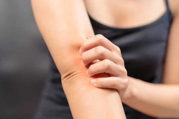 Women Hand Scratch Itch Arm Healthcare Medicine Concept — Stock Photo, Image