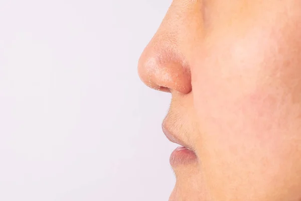 冬シーズンのクローズ アップにアトピー性皮膚炎乾燥した鼻と唇があるアレルギーの女性 — ストック写真