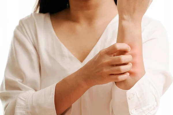 Mulheres Mão Coçar Coceira Braço Cuidados Saúde Medicina Conceito — Fotografia de Stock