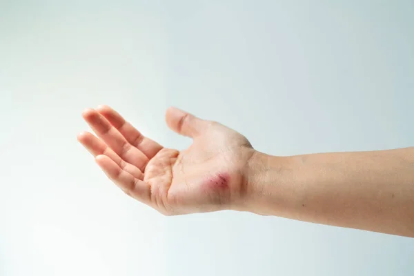 Herida por arañazos en el primer plano de la mano femenina, cuidado de la salud y medicina concepto —  Fotos de Stock