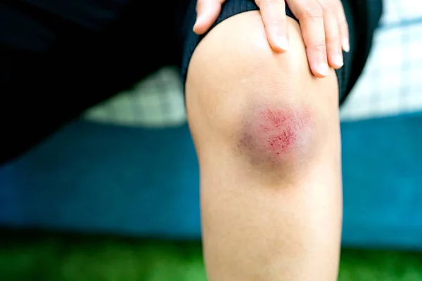 Kratzwunde am Knie einer Frau, Gesundheits- und Medizinkonzept — Stockfoto