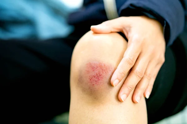 Herida por arañazos en el primer plano de la rodilla femenina, cuidado de la salud y concepto de medicina —  Fotos de Stock