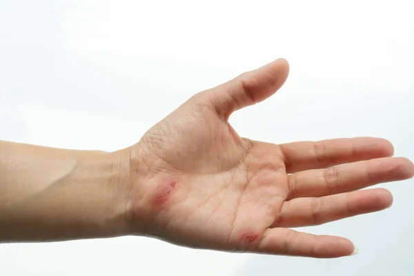 Herida por arañazos en el primer plano de la mano femenina, cuidado de la salud y medicina concepto —  Fotos de Stock