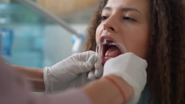 Clareamento profissional dos dentes cosméticos . — Vídeo de Stock