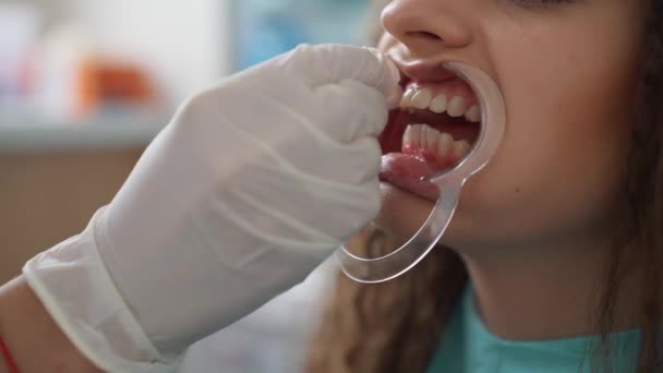 Профессиональное косметическое отбеливание зубов . — стоковое видео