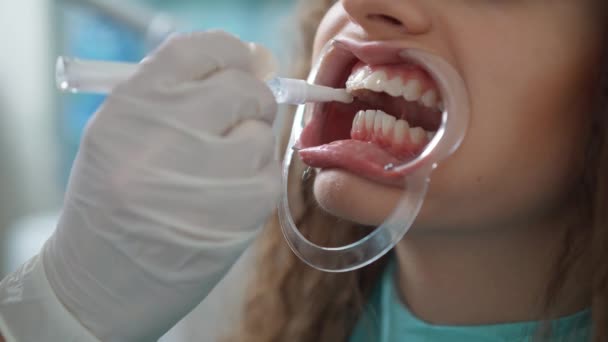Professionele cosmetische tanden whitening. — Stockvideo