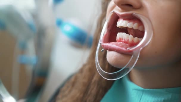 Sbiancamento professionale dei denti cosmetici . — Video Stock