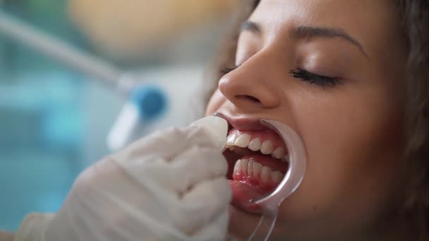 Professionelle kosmetische Zahnaufhellung. — Stockvideo