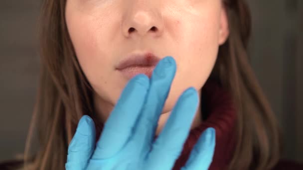 Herpes på läpparna flickor — Stockvideo