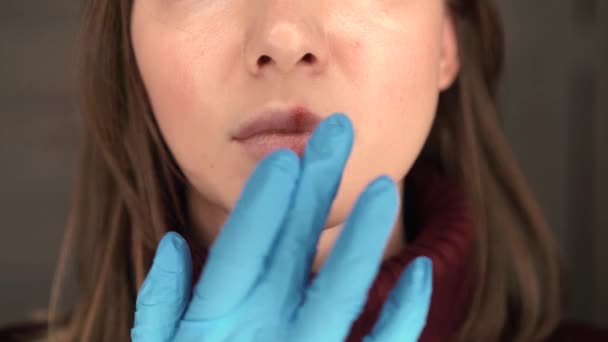 Herpes auf den Lippen der Mädchen — Stockvideo