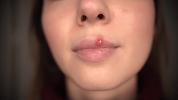 Герпес на губах девочек — стоковое видео