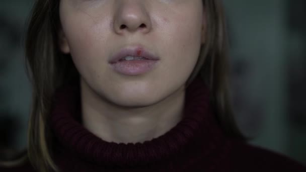 Herpes auf den Lippen, Teil eines Frauengesichts mit Finger auf den Lippen mit Herpes, Schönheitskonzept — Stockvideo