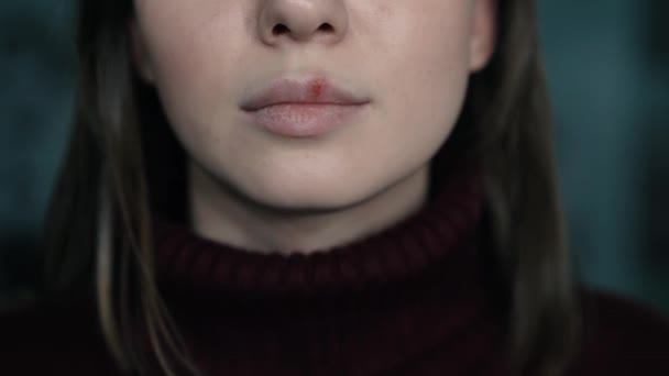 Герпес на губах, часть женского лица с пальцем на губах с герпесом, концепция красоты — стоковое видео