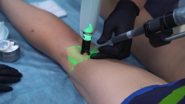 Sclerotherapy är en metod för behandling av spindelvener, ibland åderbråck, och venösa missbildningar.V aricose, Sclerotherapy och Vein Viewer — Stockvideo