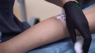 Bir doktor varis ve örümcek damarlarını yoketmek için kullanılan tıbbi prosedürleri uygular. Solüsyonun doğrudan damara enjekte edilmesi..