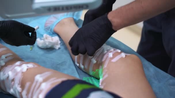Ein Arzt macht medizinische Verfahren Sklerotherapie verwendet, um Krampfadern und Besenreiser zu beseitigen. Injektion einer Lösung direkt in die Vene. — Stockvideo