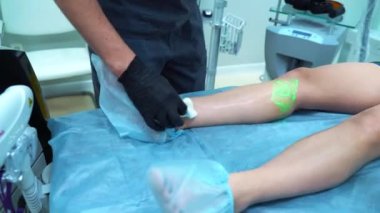 Bir doktor varis ve örümcek damarlarını yoketmek için kullanılan tıbbi prosedürleri uygular. Solüsyonun doğrudan damara enjekte edilmesi..