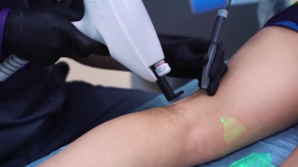 Ein Arzt macht medizinische Verfahren Sklerotherapie verwendet, um Krampfadern und Besenreiser zu beseitigen. Injektion einer Lösung direkt in die Vene. — Stockvideo