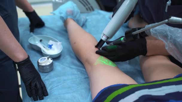 Een arts doet een medische procedure Sclerotherapie gebruikt om spataderen en spinnen aderen te elimineren. Een injectie van een oplossing rechtstreeks in de ader. — Stockvideo