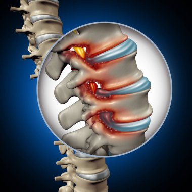 Spinal Stenosis medical concept as a degenerative illness in the human vertebrae causing compressed spine nerves human body disease as a 3D illustration. clipart