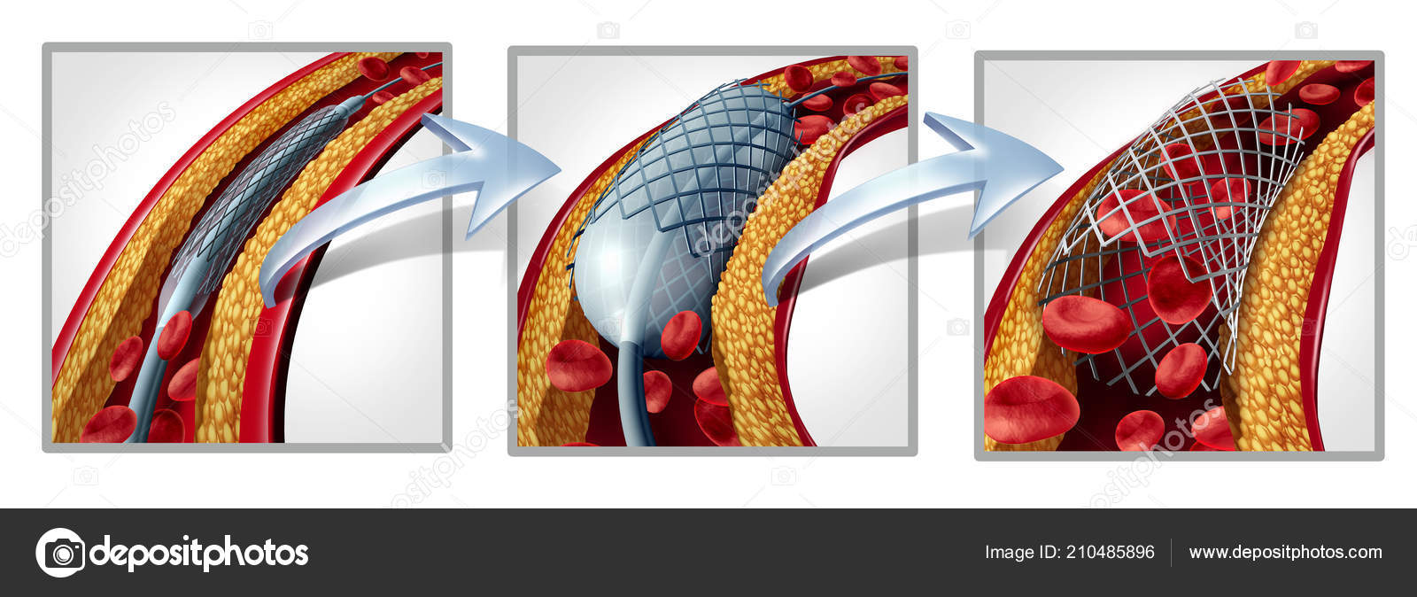 Coronary Stent Angioplasty Concept Heart Disease Treatment Symbol