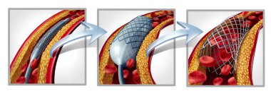 Coronary stent and angioplasty concept as a heart disease treatment symbol diagram with the stages of an implant procedure in an artery that has cholesterol plaque blockage being opened for increased blood flow as a 3D illustration. clipart