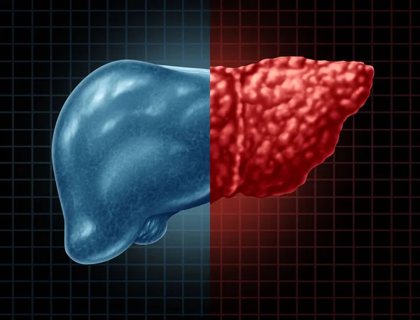 脂肪肝和肝脂肪变性身体部分作为医疗保健概念消化系统解剖和重要器官消化功能的3D 插图风格 — 图库照片